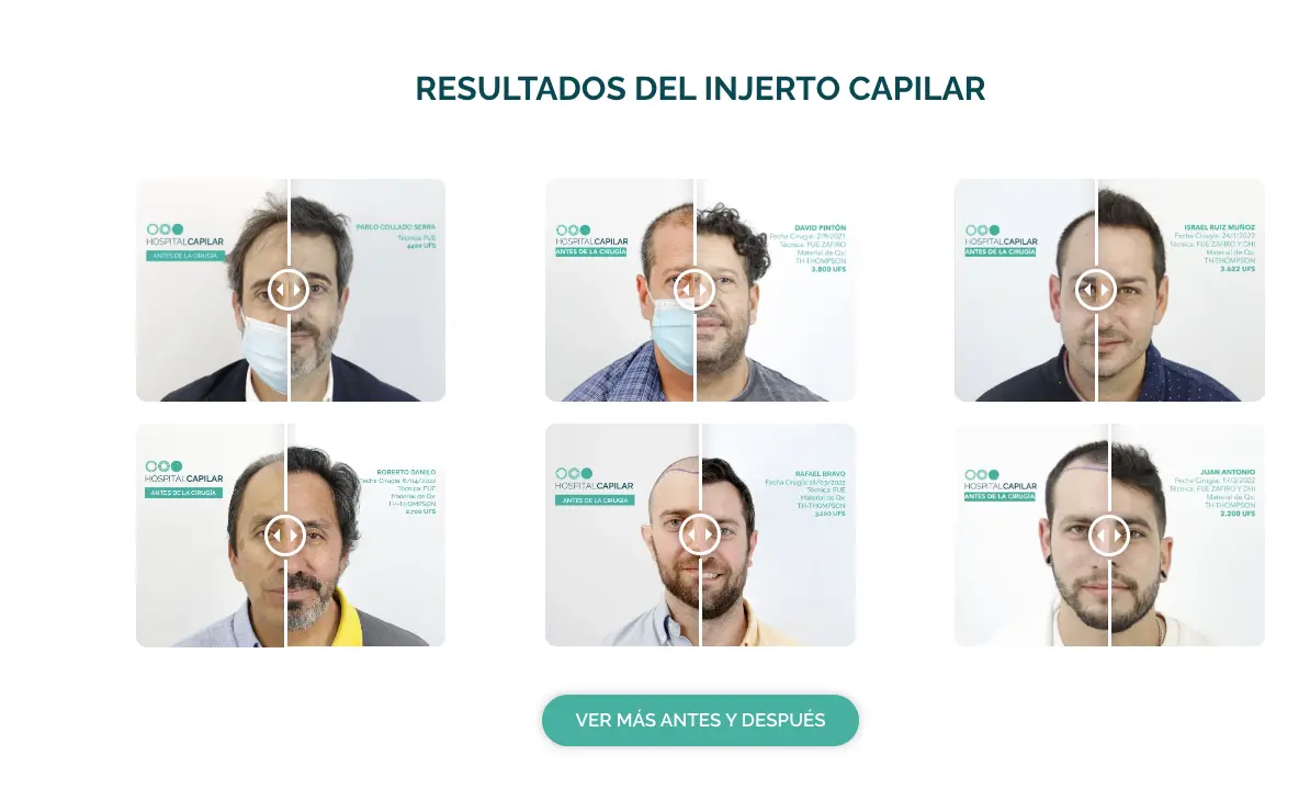 Hospital Capilar resultados antes y despues injerto capilar
