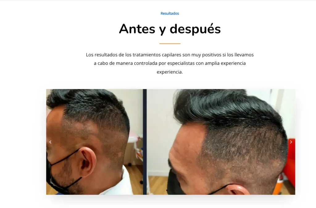 Clínica Capilar Laura Agrelo pagina web ejemplos de injertos capitales