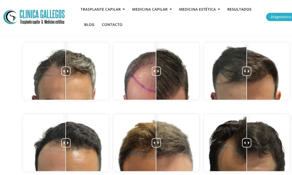 Clínica Gallegos Clínica Capilar pagina web resultados injertos