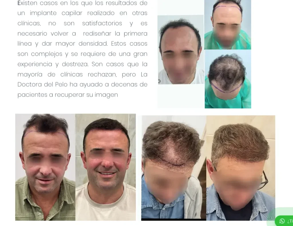 La Doctora del Pelo Clínica Capilar Madrid resultados pacientes